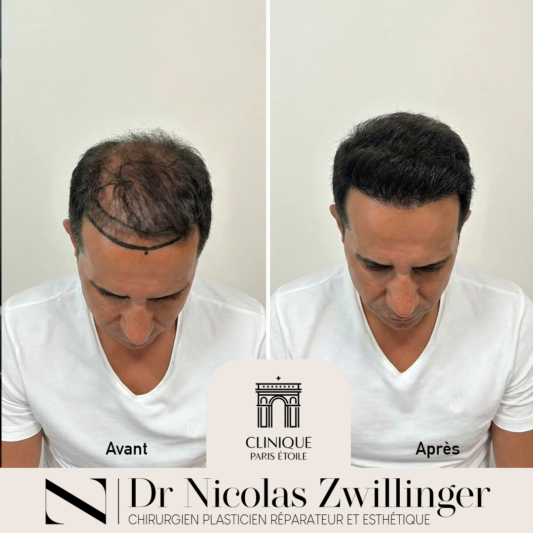 Before and After – ZIP1