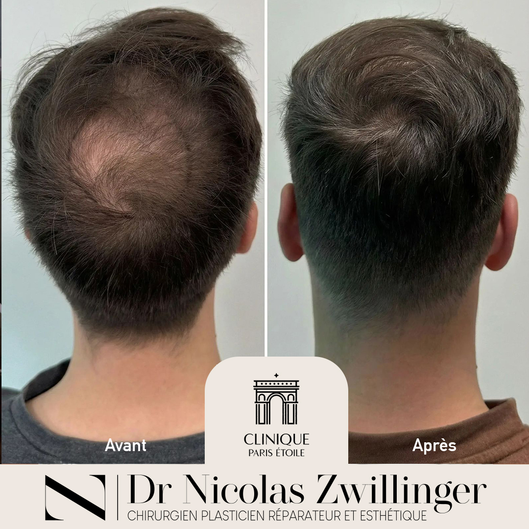 Before and After – ZIP2